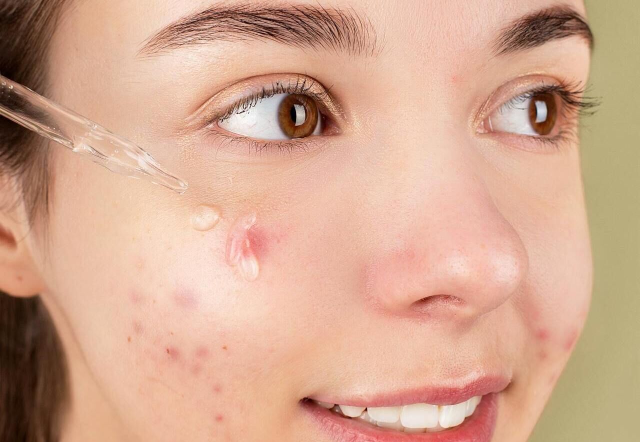 Kolajen Sivilce Yapar mı?